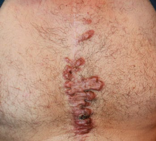 chest keloid