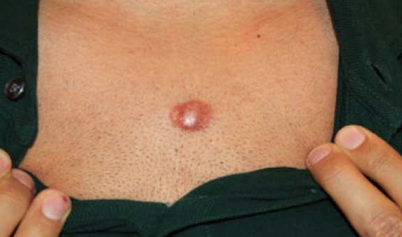 chest keloid