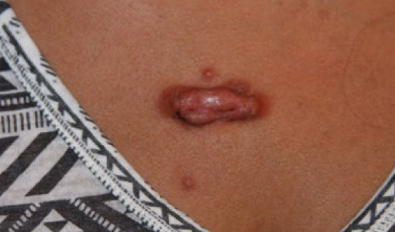 chest keloid