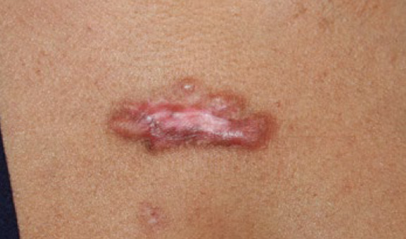 chest keloid