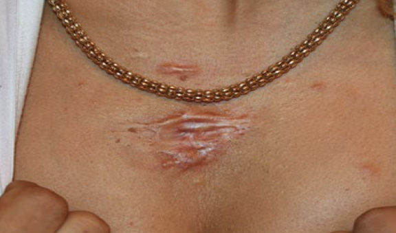 chest keloid