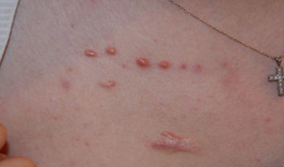 chest keloid