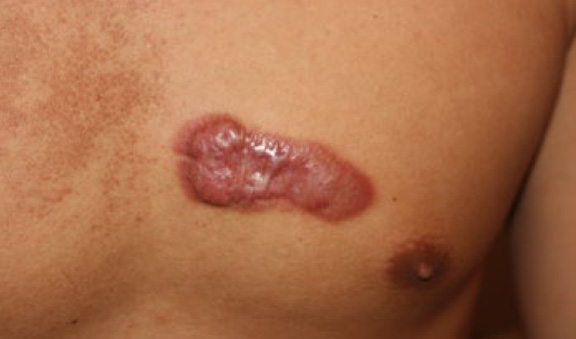 chest keloid