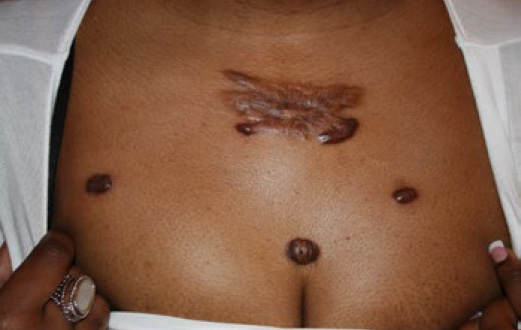 chest keloid