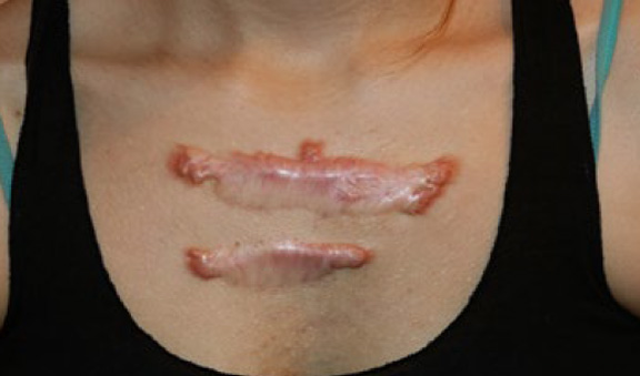 chest keloid