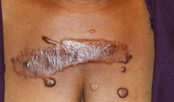 chest keloid