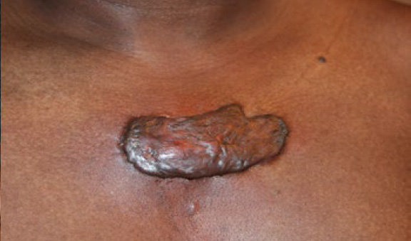 chest keloid