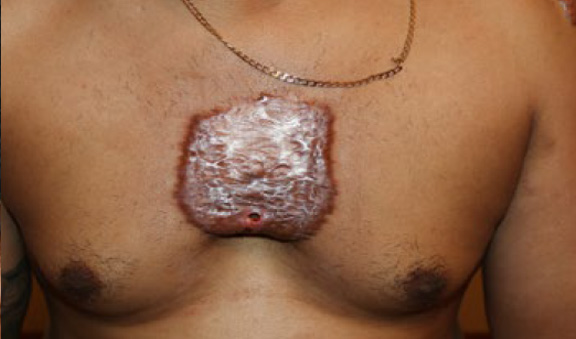 chest keloid