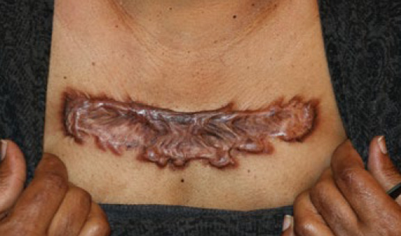 chest keloid