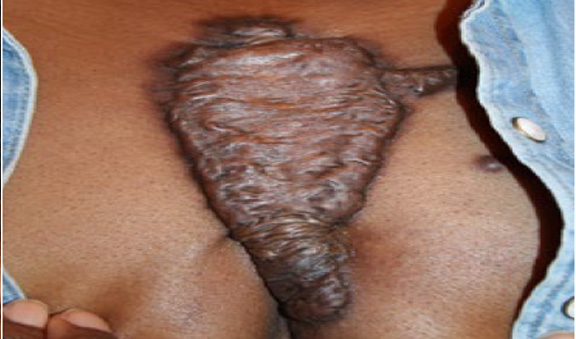 chest keloid