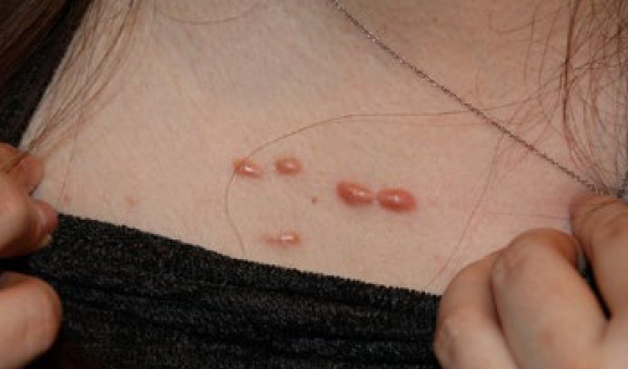 chest keloid