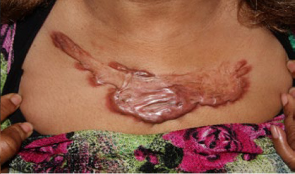 chest keloid