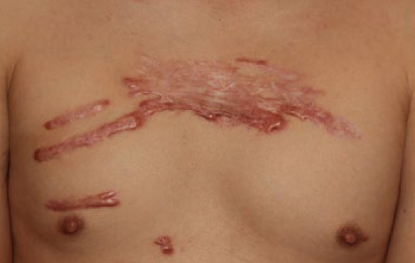 chest keloid