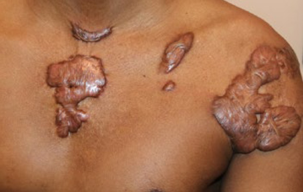 chest keloid