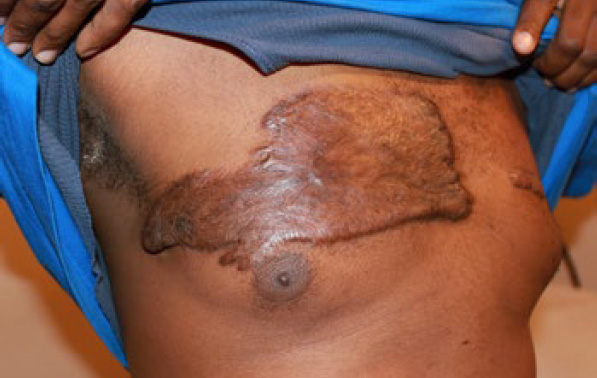 chest keloid