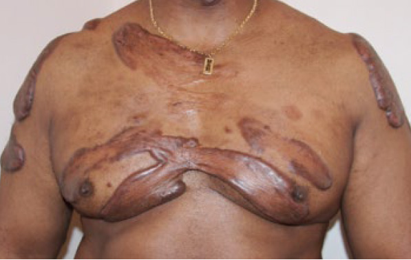 chest keloid