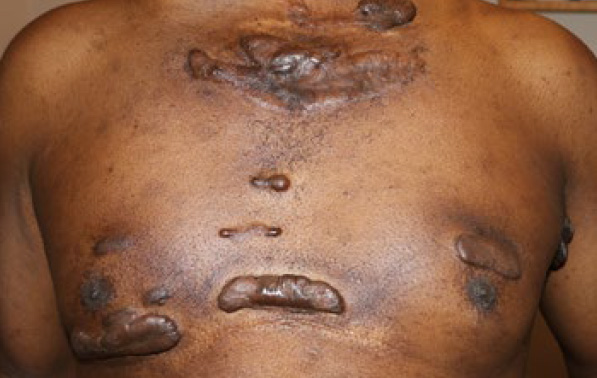 chest keloid