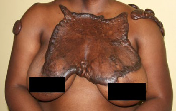 chest keloid