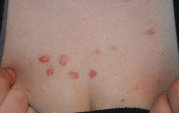 chest keloid