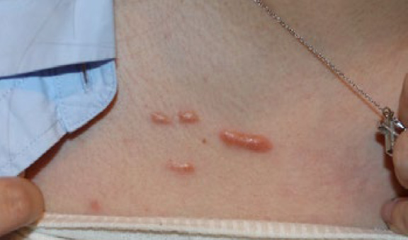 chest keloid