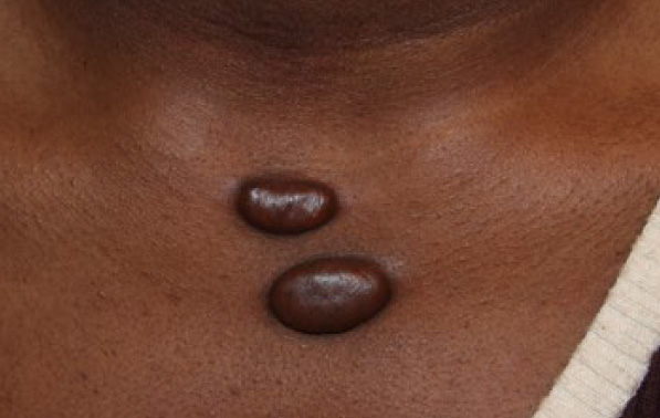 chest keloid