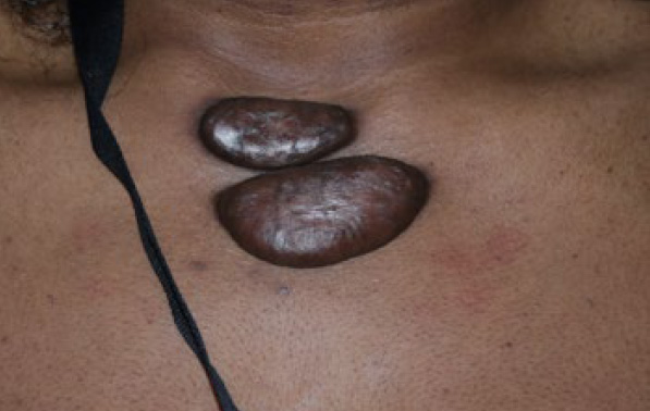 chest keloid