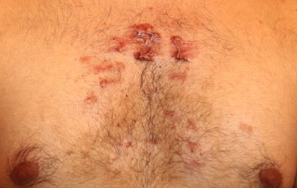 chest keloid