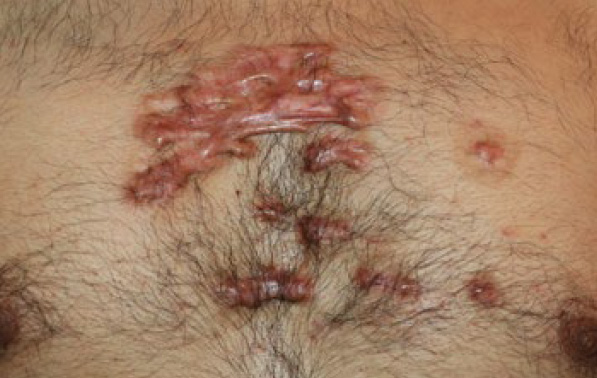 chest keloid