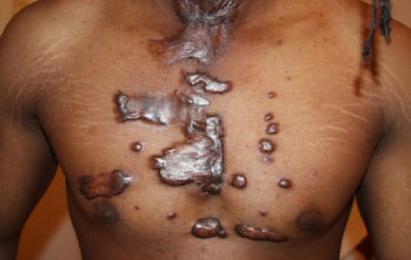 chest keloid