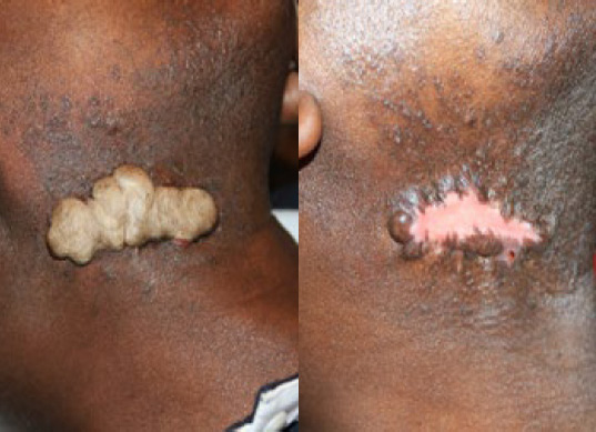 neck keloid