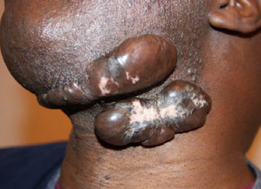 neck keloid