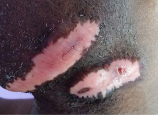 neck keloid