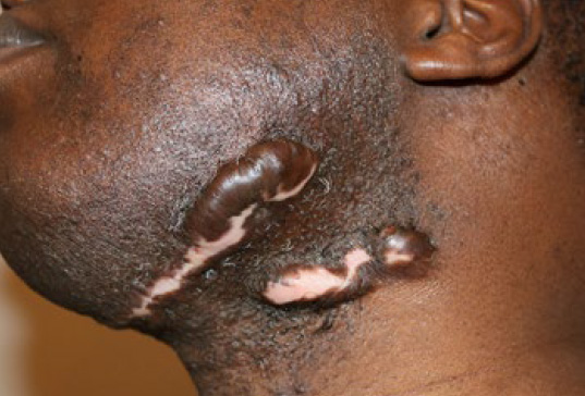 neck keloid