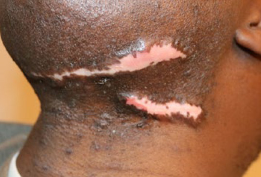 neck keloid