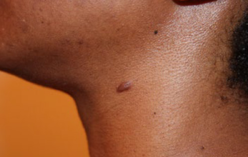 neck keloid