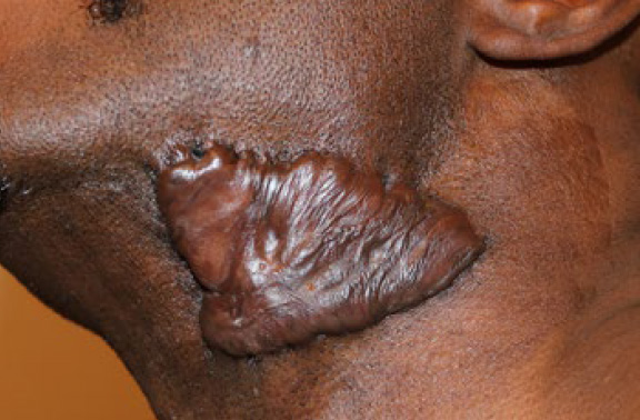 neck keloid