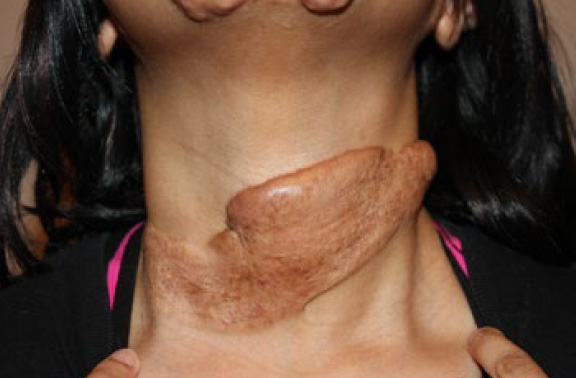 neck keloid