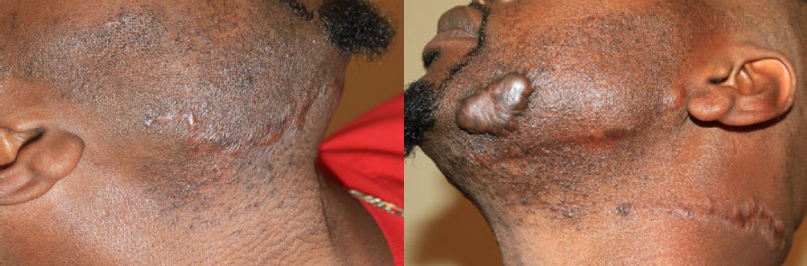 neck keloid