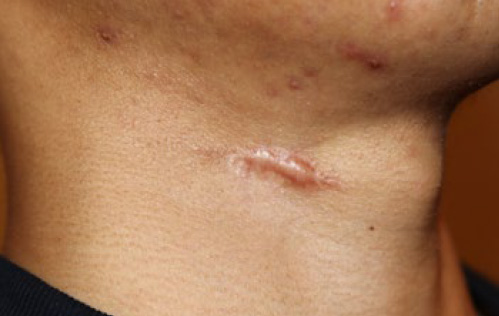 neck keloid