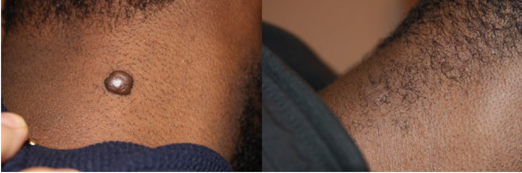 neck keloid