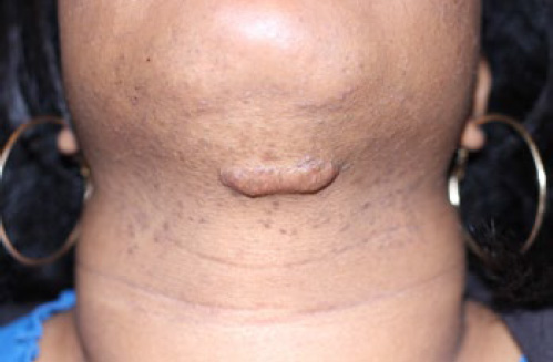 neck keloid