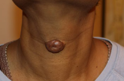 neck keloid