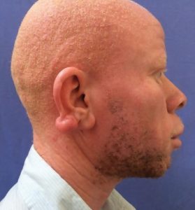 albinism 