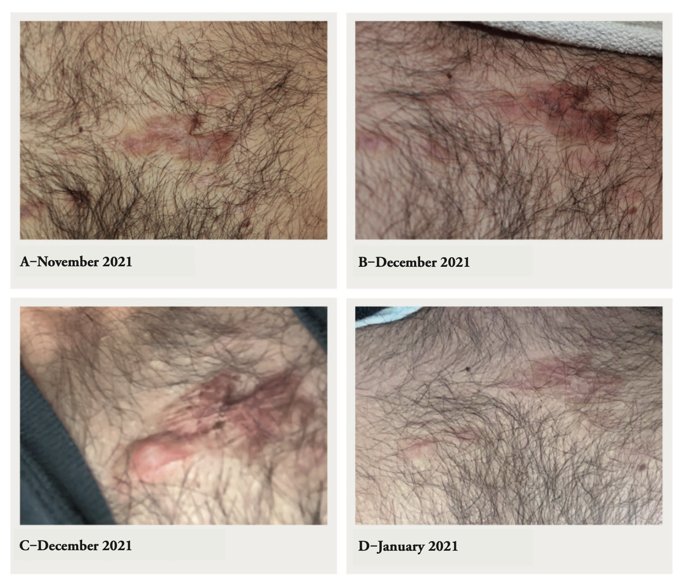 Impact of COVID-19 on Keloids - Case Report