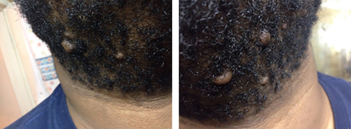 Figure 16: December 2014, before undergoing surgery. Photographs from patient’s archives. Figure 16: December 2014, before undergoing surgery. Photographs from patient’s archives.