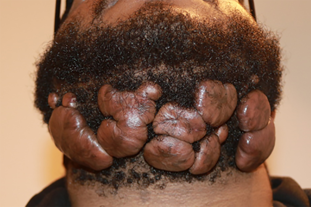 Figure 17: A 24-year-old African American man presented in February 2017 with multifocal, massive neck keloids following surgical removal of small neck keloids and intralesional steroid injection. Figure 17: A 24-year-old African American man presented in February 2017 with multifocal, massive neck keloids following surgical removal of small neck keloids and intralesional steroid injection.