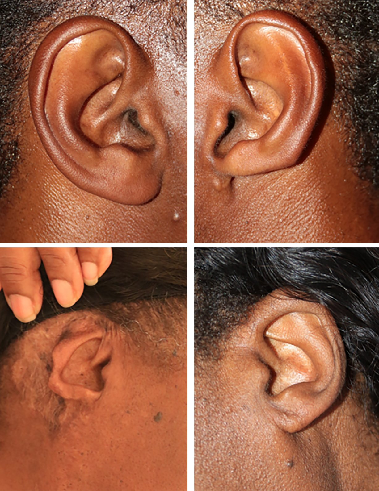 Figure 18: Loss of ear tissue following ear keloid surgery and comparison to the opposite ear without loss of tissue, an unreported outcome. Figure 18: Loss of ear tissue following ear keloid surgery and comparison to the opposite ear without loss of tissue, an unreported outcome.